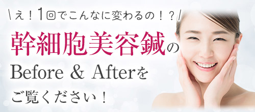 幹細胞美容鍼ビフォーアフタータイトル