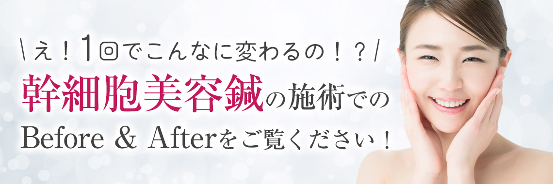 幹細胞美容鍼ビフォーアフタータイトル