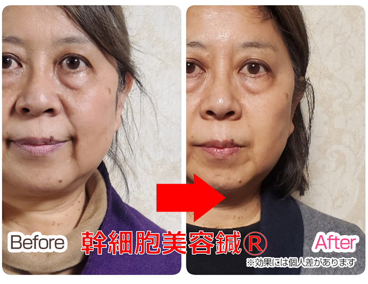 ビフォーアフター1